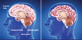 Mengenal Frontotemporal Dementia (FTD), Penyakit di Balik Menurunnya Kondisi Bruce Willis